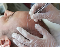 Top Hair Transplant Clinic in Hyderabad | Hair Clinic in Hyderabad