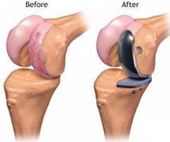 Correct Your Damaged Knee with Knee Replacement Surgery - Image 2