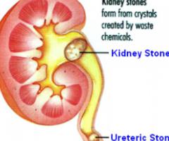 Best Solution For Urinary Stones In Kochi